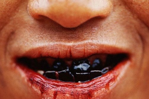 Při žvýkání betelu mají domorodci červené sliny a zkažené zuby Při žvýkání betelu mají domorodci červené sliny a zkažené zuby